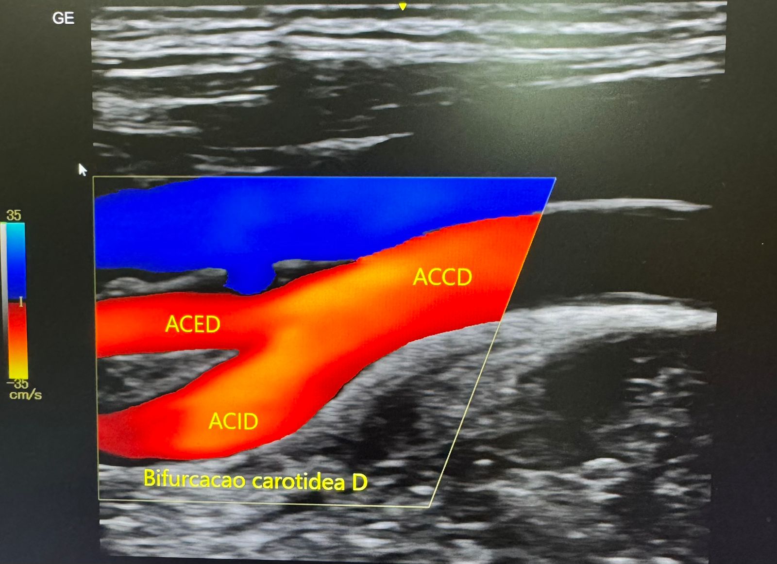 EcoColorDoppler mostrando uma carótida normal