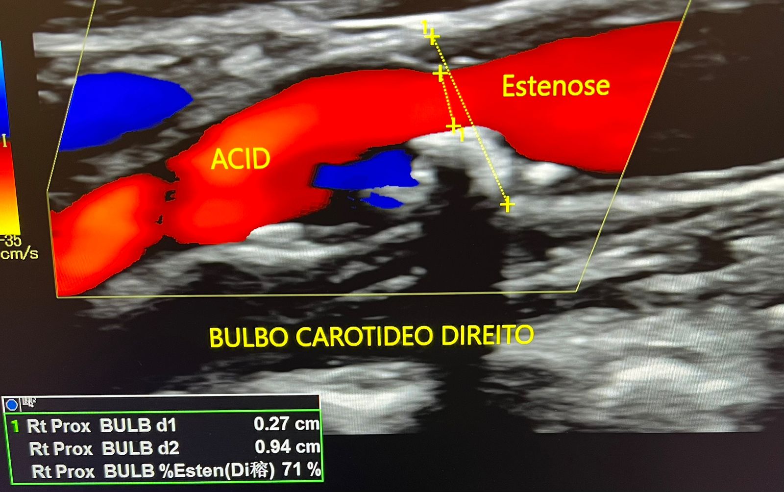 EcoColorDoppler mostrando carótida com placa de ateroma