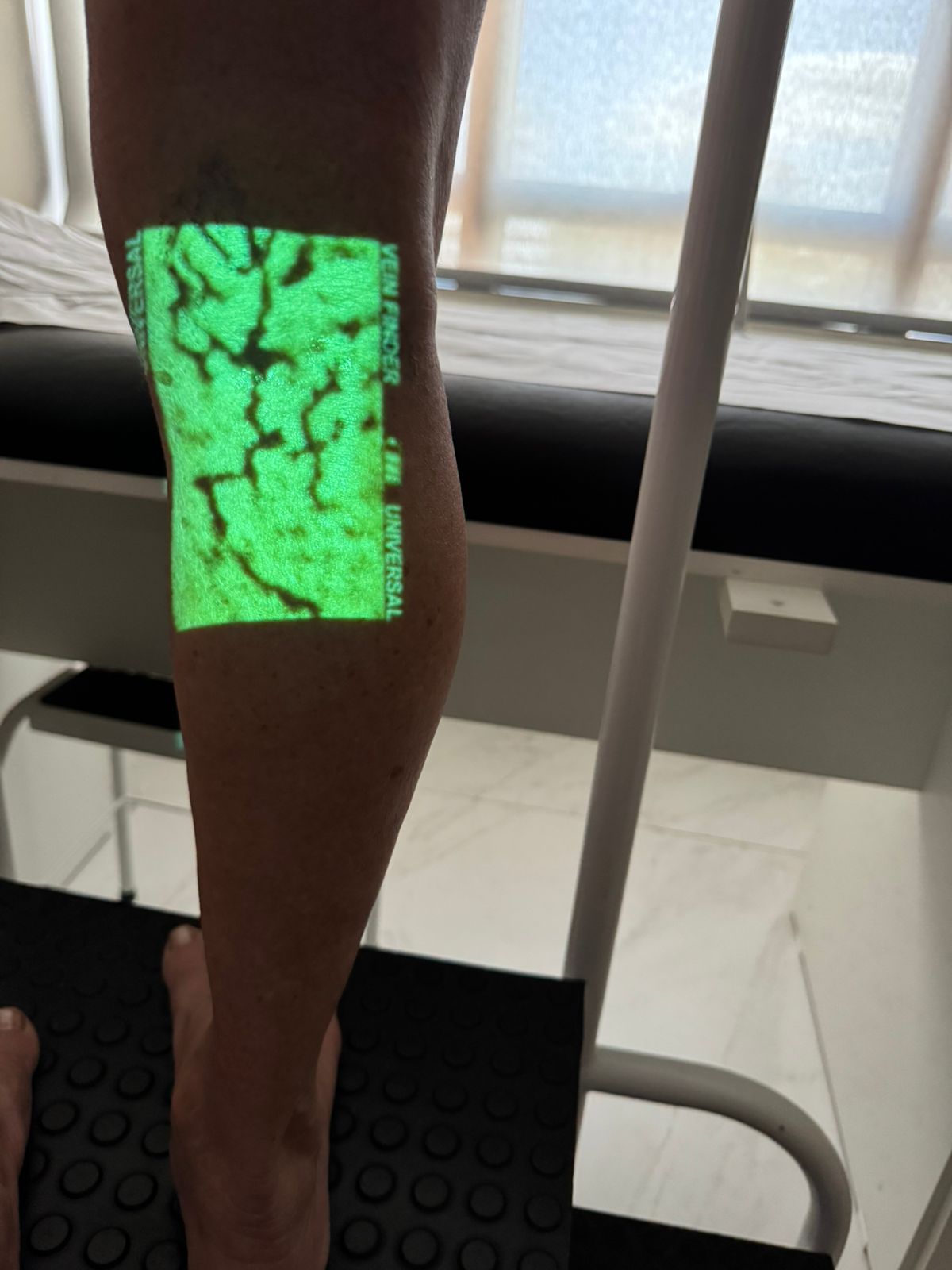 Mapeamento de veias superficiais projetado sobre a perna com realidade aumentada vascular