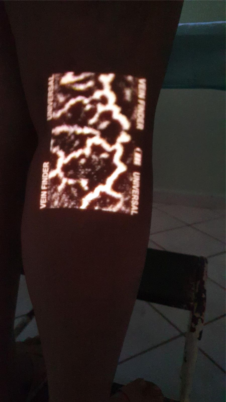Visualização das veias da perna com equipamento de realidade aumentada vascular