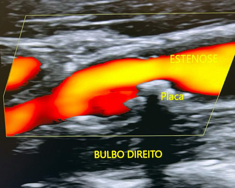 EcoColorDoppler de artéria carótida com placa
