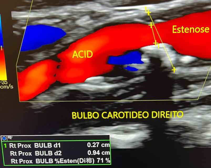 EcoColorDoppler de carótida mostrando estenose