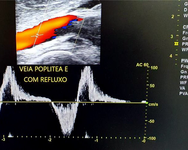 EcoColorDoppler vascular demonstrando refluxo em veia poplítea