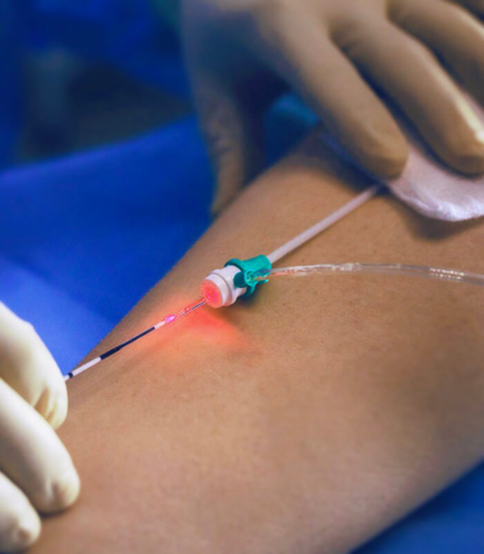 Procedimento de endolaser de safena com a luz da fibra visível sob a pele