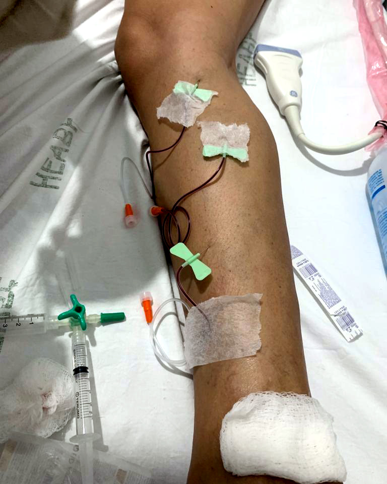 Procedimento vascular com espuma densa