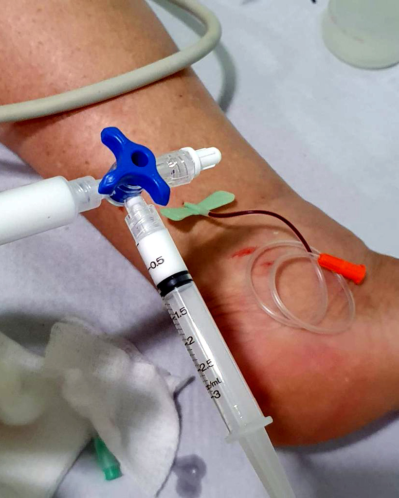 Aplicação de espuma densa em varizes