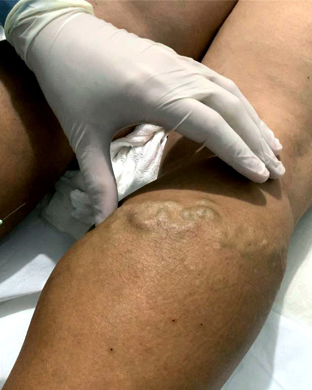 Procedimento em veias varicosas da perna