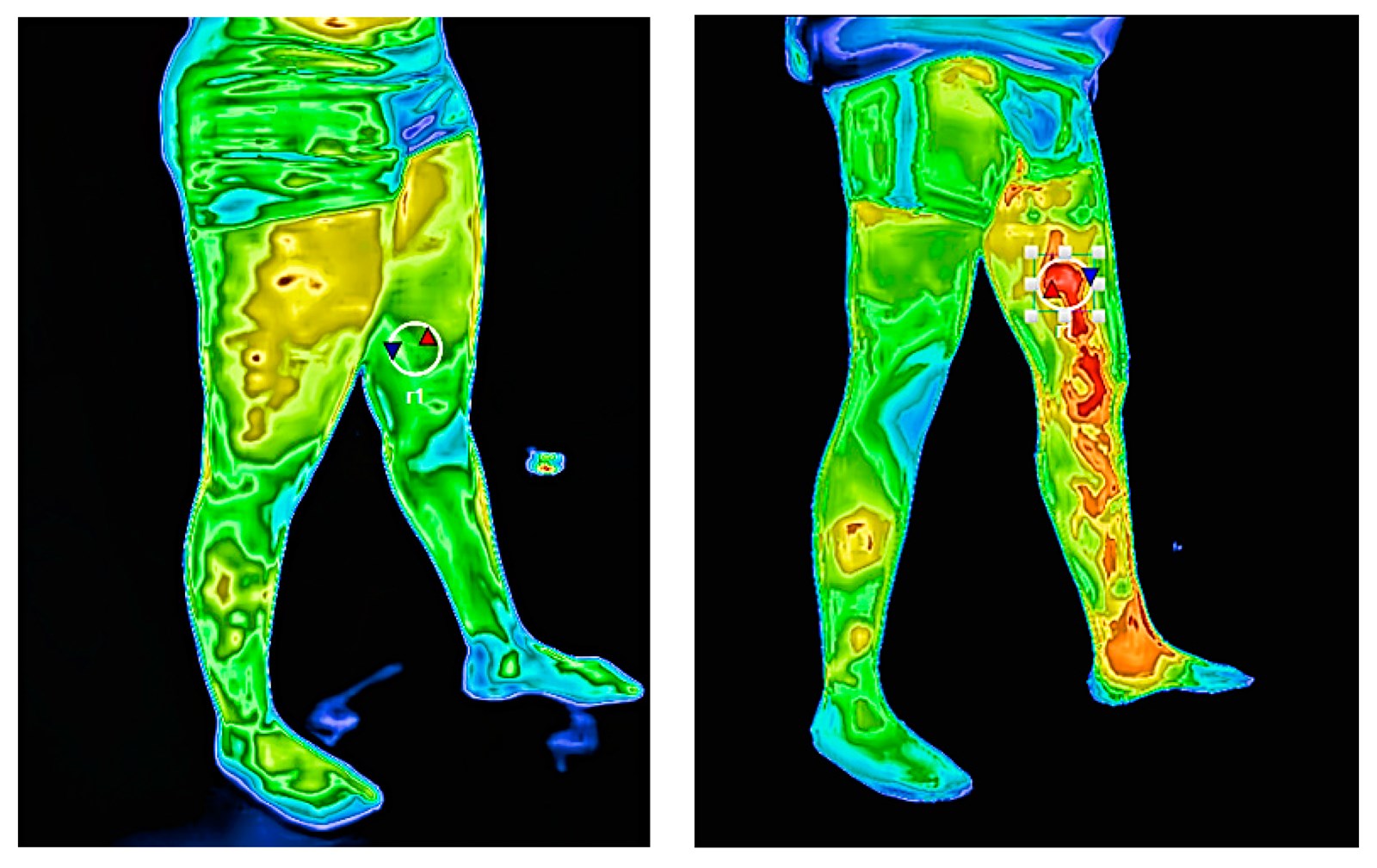 Comparação termográfica vascular das pernas com diferentes padrões de refluxo venoso